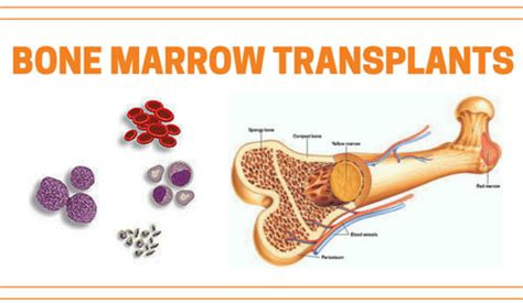 bone marrow transplant pcso|The status of blood and marrow transplantation in .